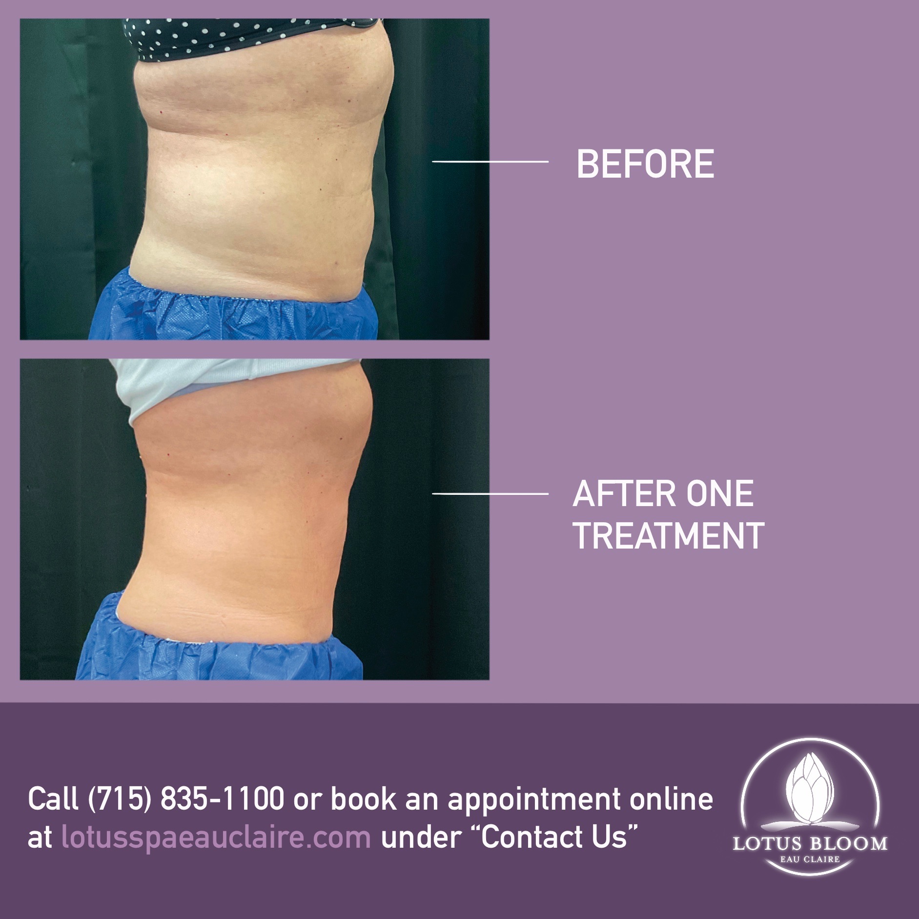 CoolSculpting: How to Prepare, Procedure, Cost, Before and After